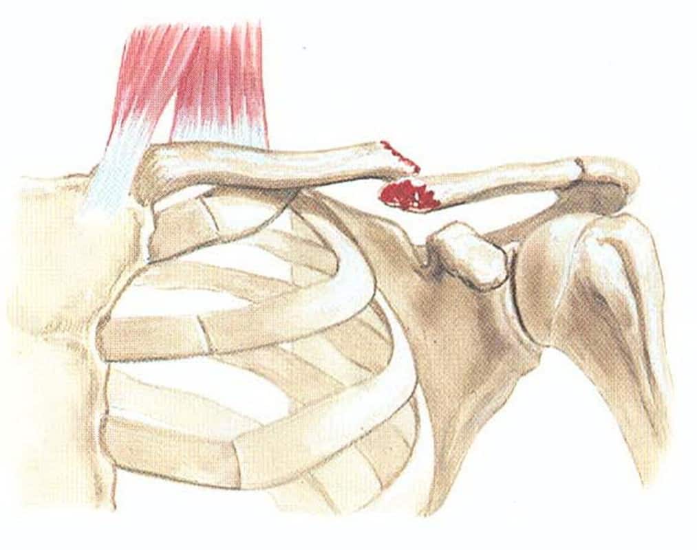 Как выглядит перелом ключицы