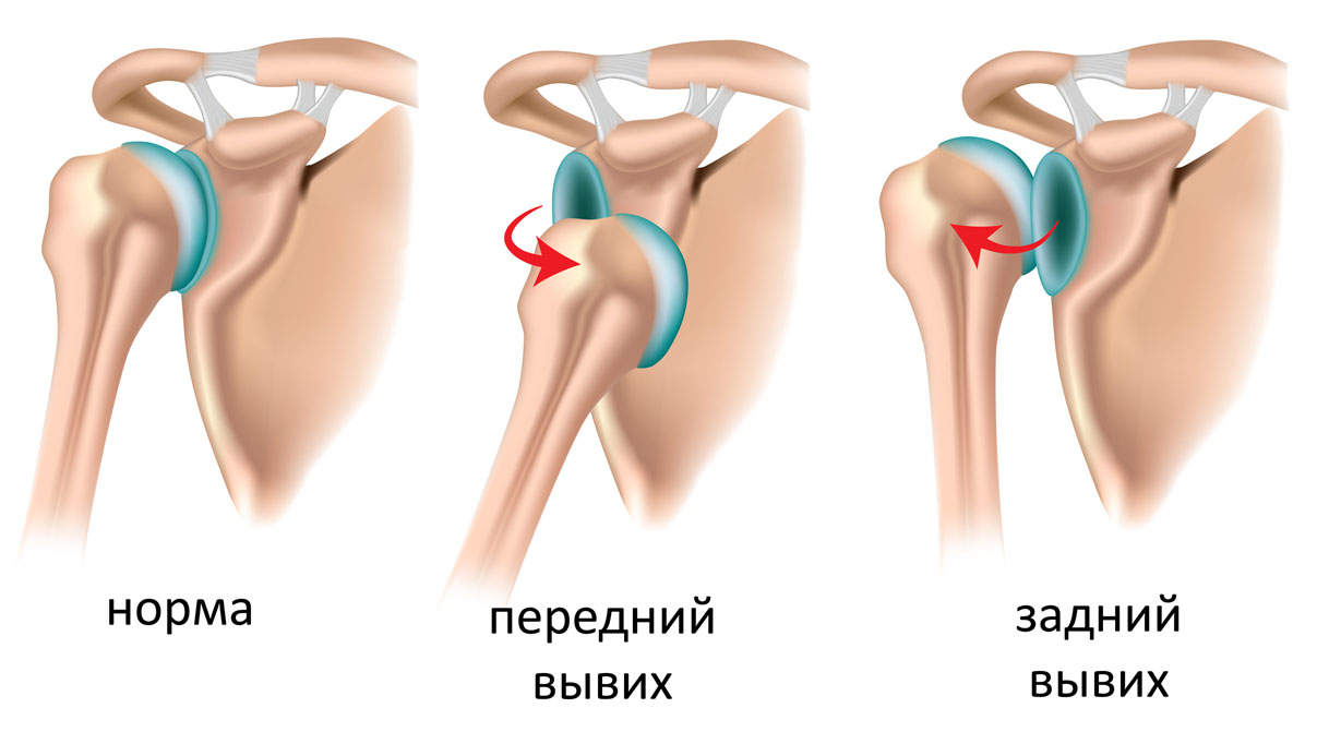 Плечо в норме и при вывихе